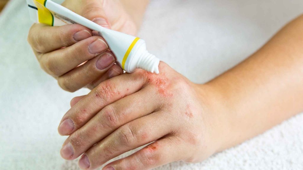 משחה להרגעת העור