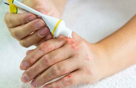 משחה להרגעת העור2